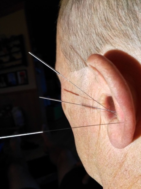 øreakupunkturnåler på et mannlig øre med svart bakgrunn
