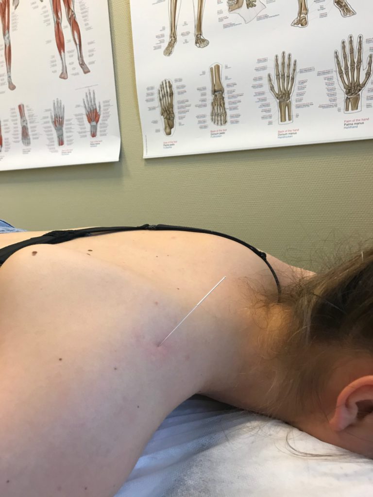 Bilde av en akupunkturnål på skulder